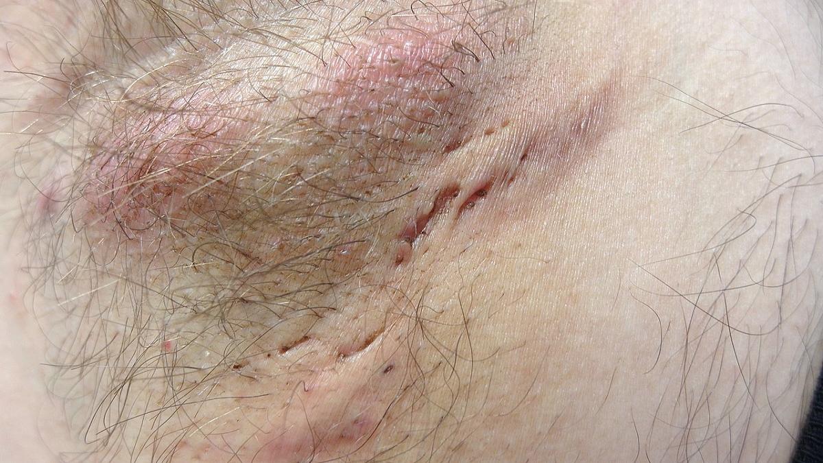 ¿Qué es la hidradenitis supurativa?