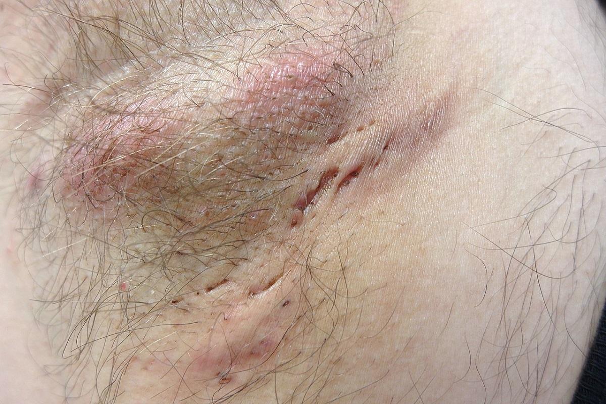 ¿Qué es la hidradenitis supurativa?