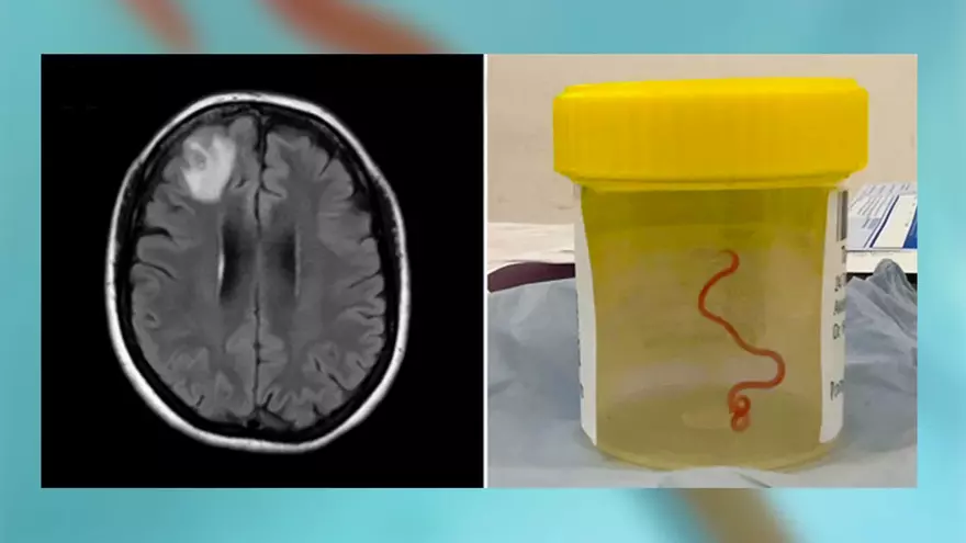 Hallan un gusano vivo de 8 cms en el cerebro de una mujer: cómo se infectó y qué síntomas tenía