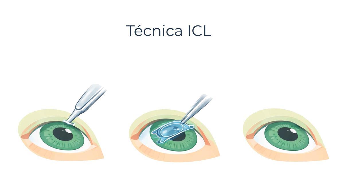 Técnica ICL
