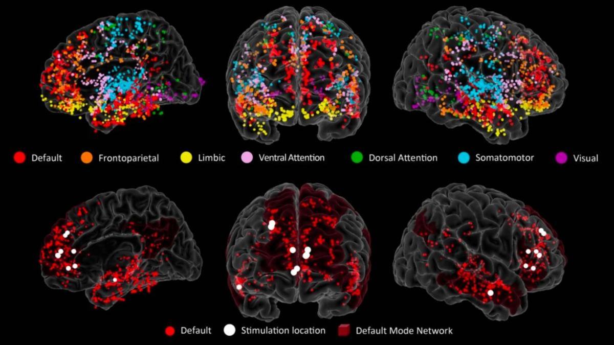 Los electrodos en múltiples regiones del cerebro dieron una mejor imagen de la actividad cerebral en tiempo real. Los puntos rojos en las imágenes inferiores muestran las ubicaciones de los electrodos en el DMN.