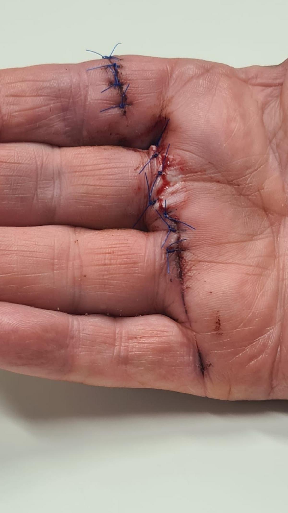 Los puntos de sutura que Ramób recibió a causa de las heridas infringidas durante el intento de atraco en su piso, en Barcelona.