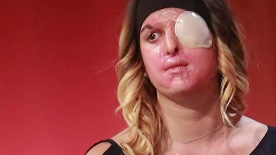 El testimonio en televisión de una modelo atacada con ácido por su expareja conmociona a Italia