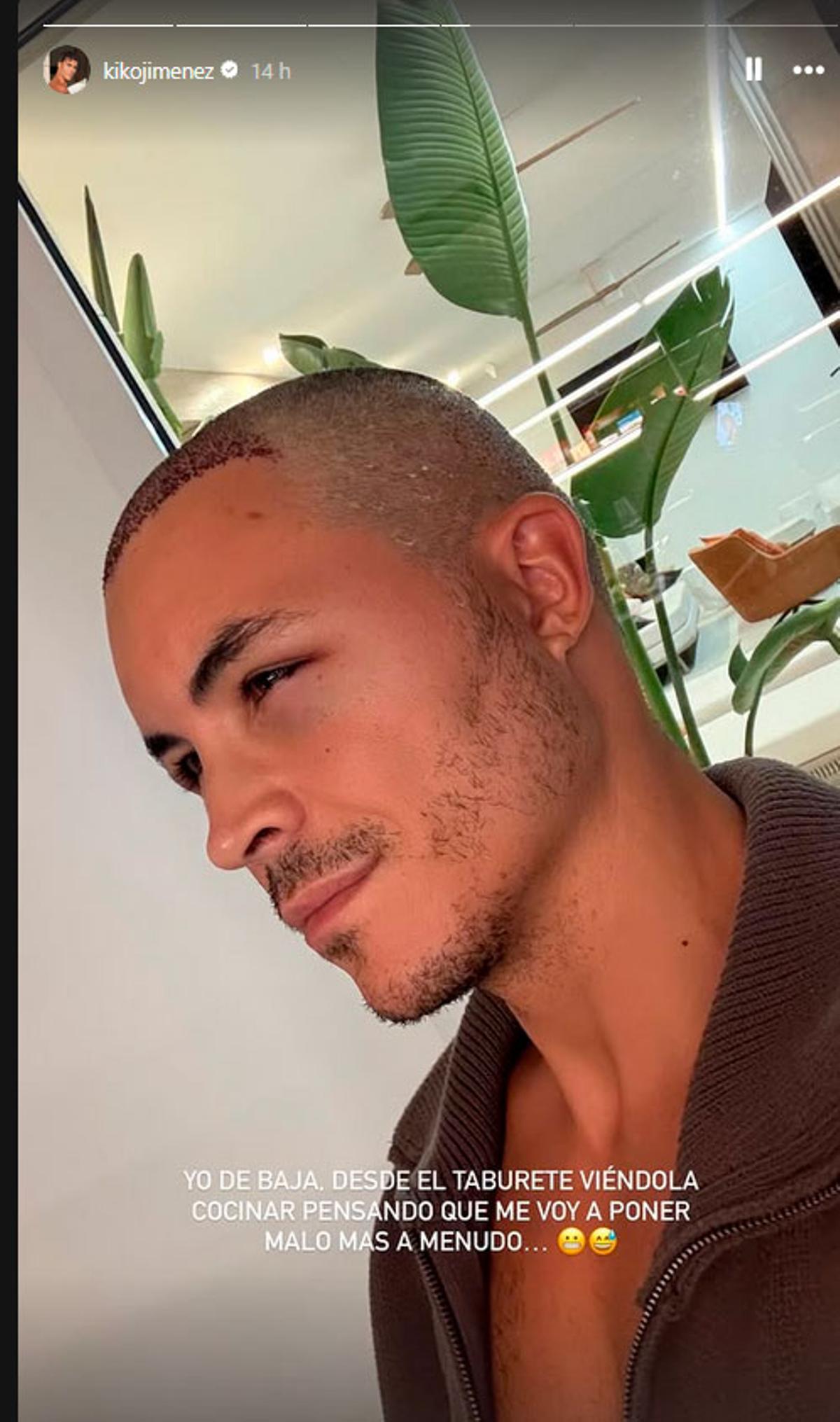 El motivo por el que Kiko Jiménez se ha tenido que hacer un injerto capilar de última hora: &quot;Por qué se opera si tenía mucho pelo&quot;