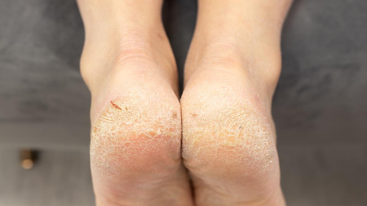 El quita durezas de Lidl te puede ayudar a mejorar el aspecto de tus pies