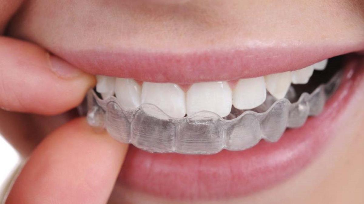 Esta es la manera adecuada de limpiar y desinfectar tu férula dental según  los dentistas