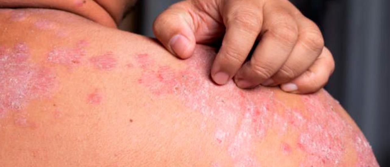 Un paciente afectado por la psoriasis.