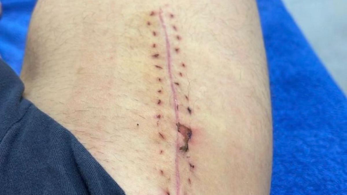 Sergi Roberto ha enseñado en sus redes la cicatriz de la operación en el muslo