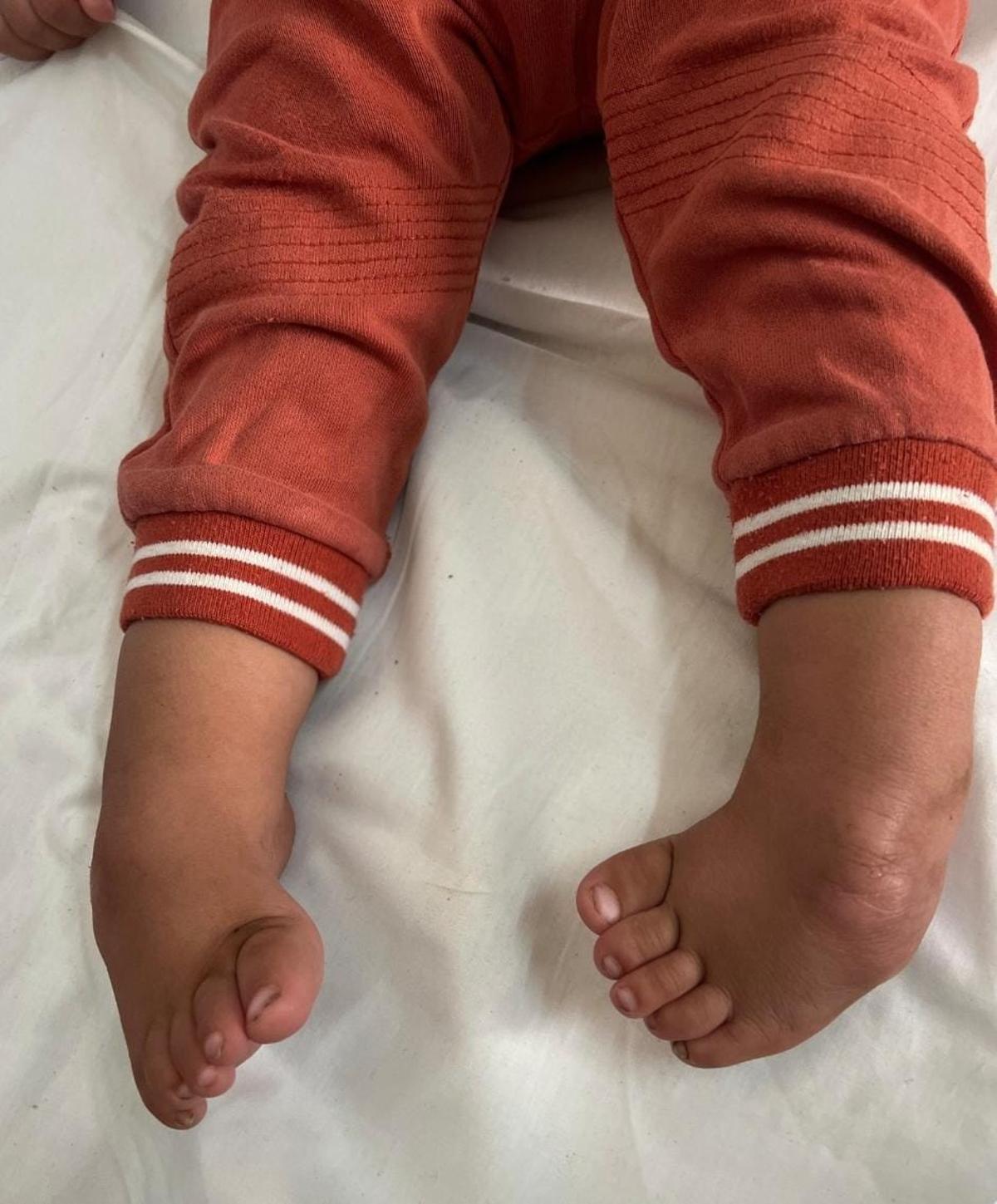 Una de las patologías tratadas en los días de la podóloga vilagarciana en el Sáhara.