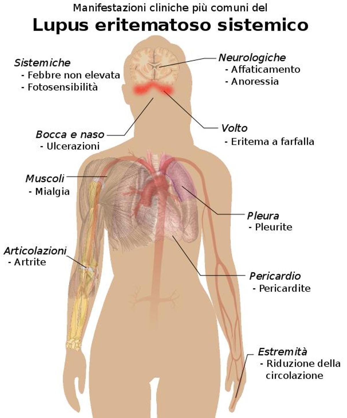 Cuadro general con los síntomas el Lupus (en italiano)