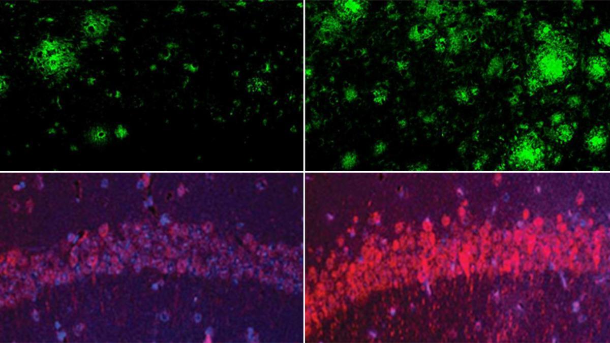 En un modelo de ratón con enfermedad de Alzheimer, la deficiencia de litio (arriba, derecha) aumentó drásticamente los depósitos de beta amiloide en el cerebro: lo mismo ocurrió con la proteína tau del enredo neurofibrilar del Alzheimer (abajo, derecha).