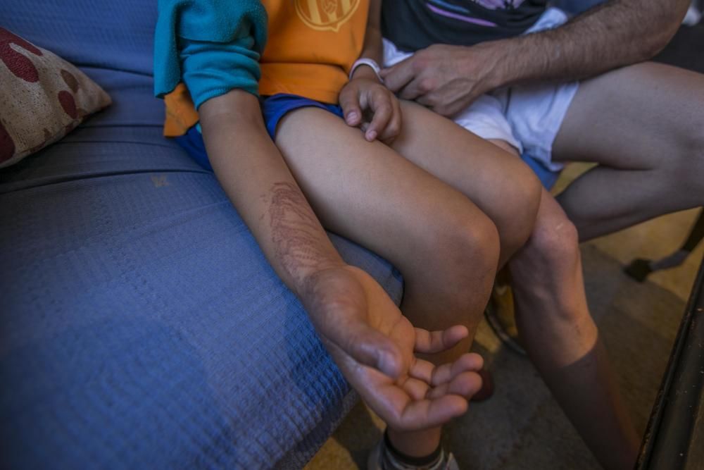 El niño que fue atendido por el contacto con la medusa portuguesa en la playa de La Marina lleva dos días sin ir al colegio por las molestias que todavía tiene en el brazo