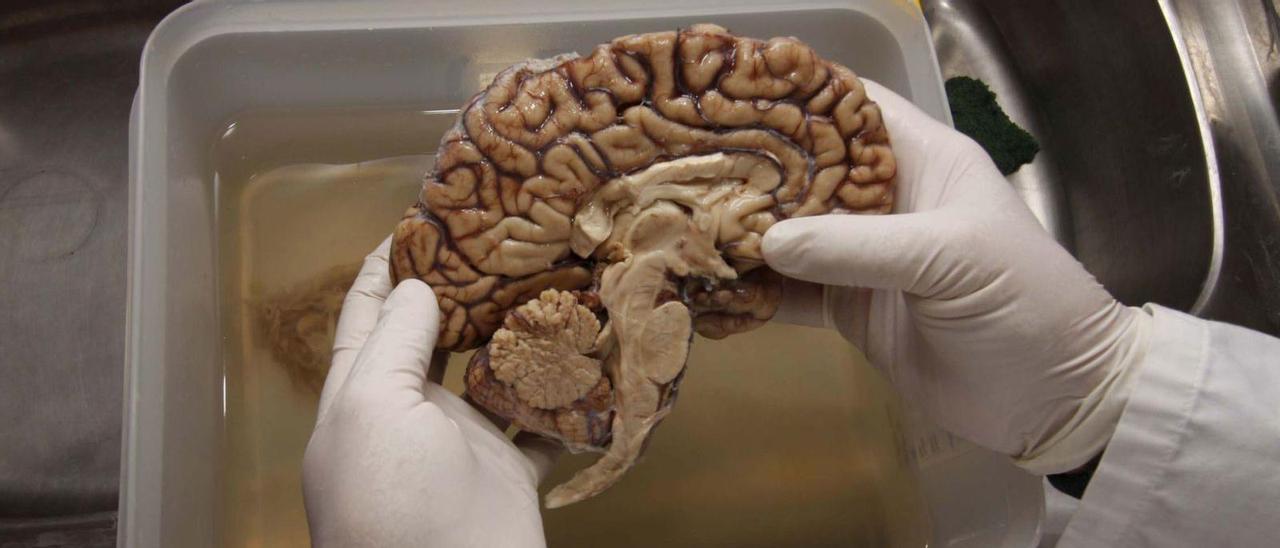 Un investigador sostiene un cerebro en un laboratorio de neuropatología.