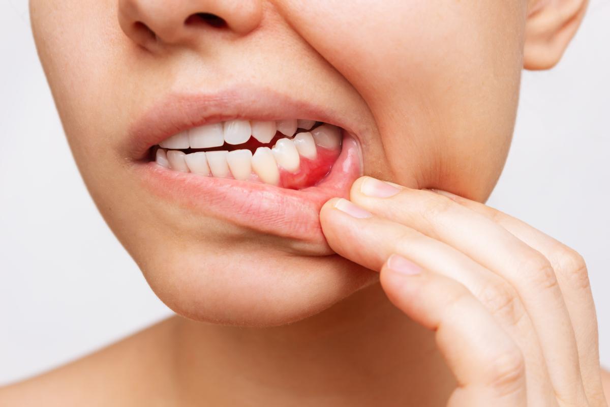Hay que prestar atención a los síntomas, como una mancha de color blanco o rojo en la boca o una pequeña úlcera