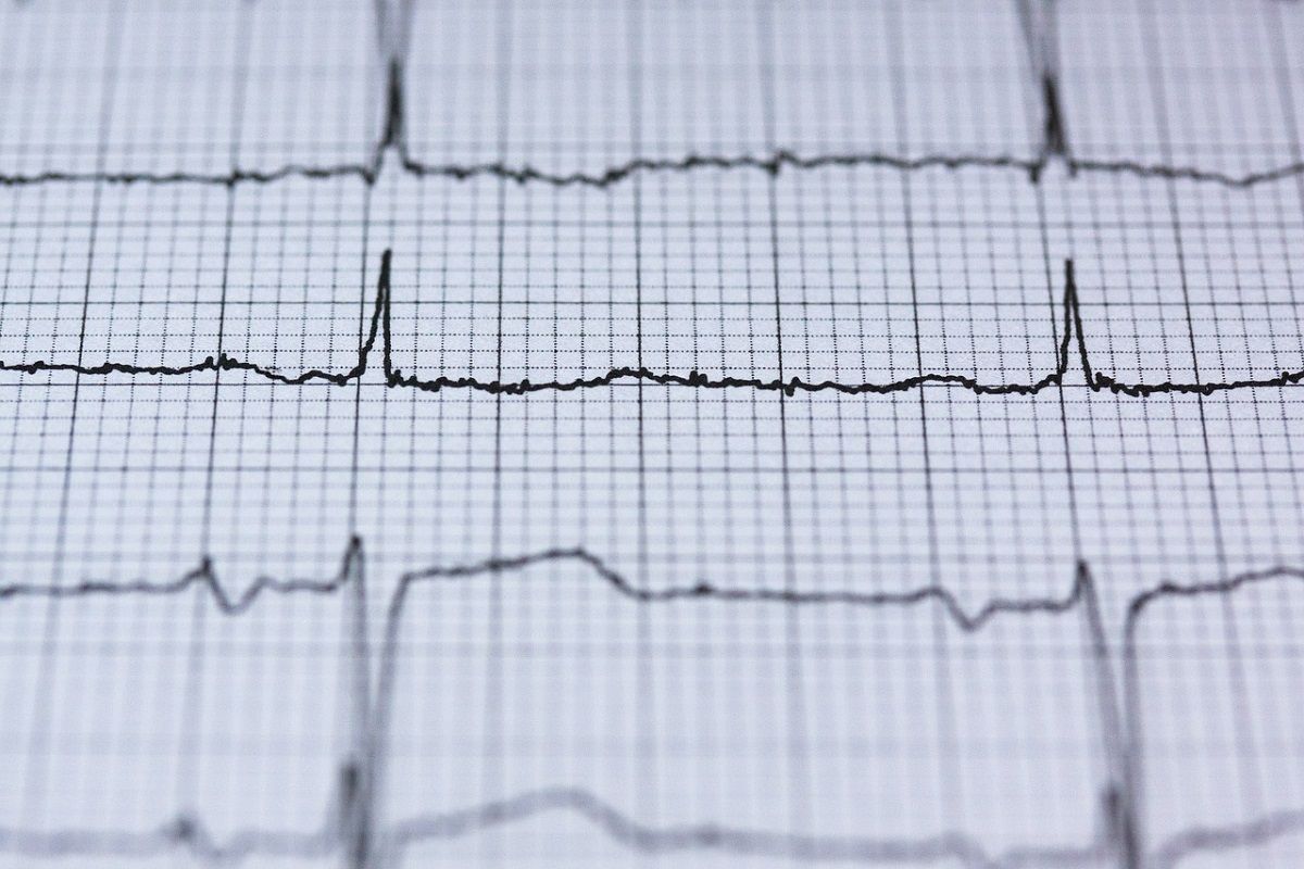 Las arritmias se pueden detectar con un electrocardiograma