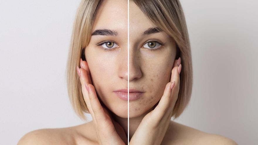 El tratamiento definitivo contra el acné para lucir una piel perfecta