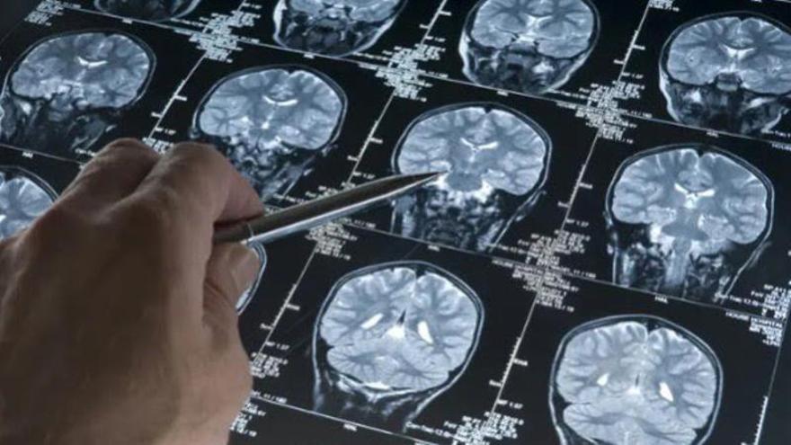 Els hospitals de Can Ruti i Sant Pau representaran Espanya en un gran estudi europeu sobre una prometedora cirurgia per a l’Alzheimer
