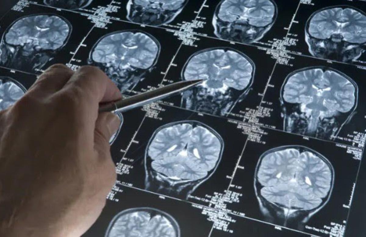 Els hospitals de Can Ruti i Sant Pau representaran Espanya en un gran estudi europeu sobre una prometedora cirurgia per a l’Alzheimer