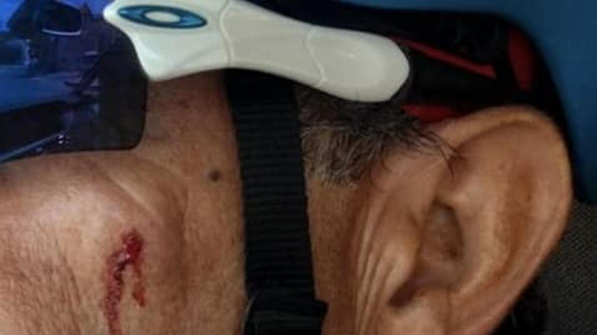 Un hombre con heridas en el rostro tras recibir un perdigonazo en Murcia.