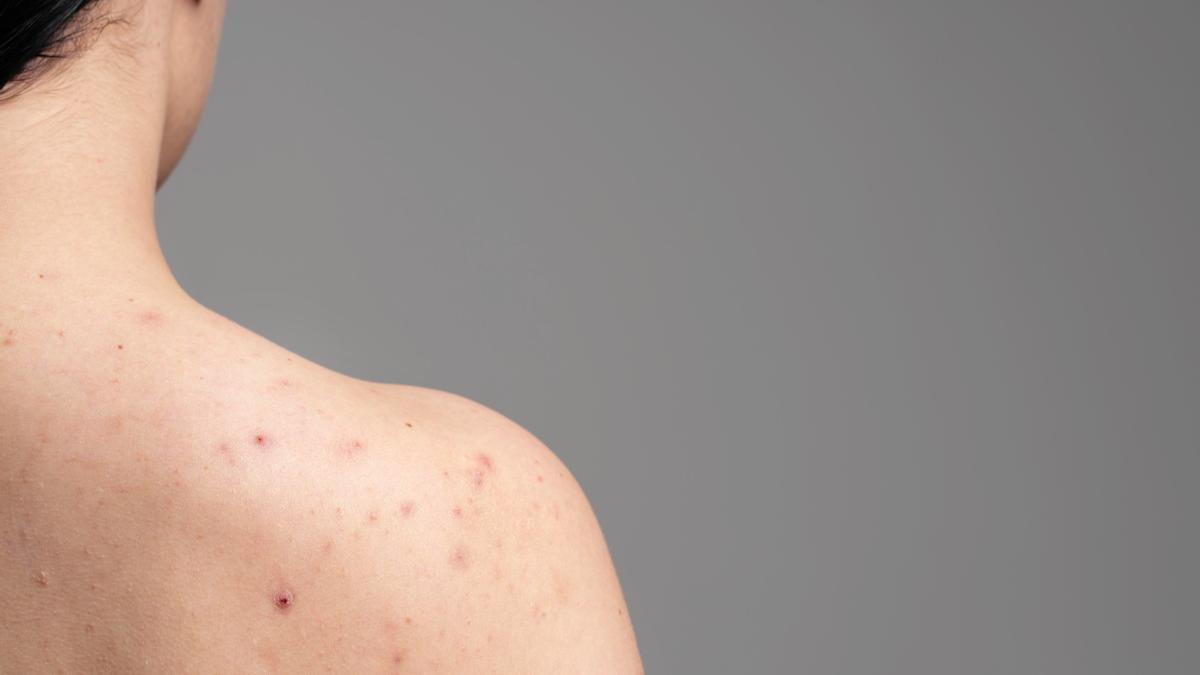 La piel se extiende a lo largo de todo el cuerpo y, con él, el acné.