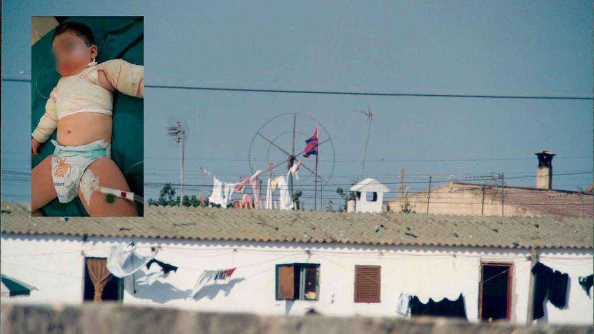 Un bebé sufre graves quemaduras al caerle encima una olla con agua hirviendo en Son Banya