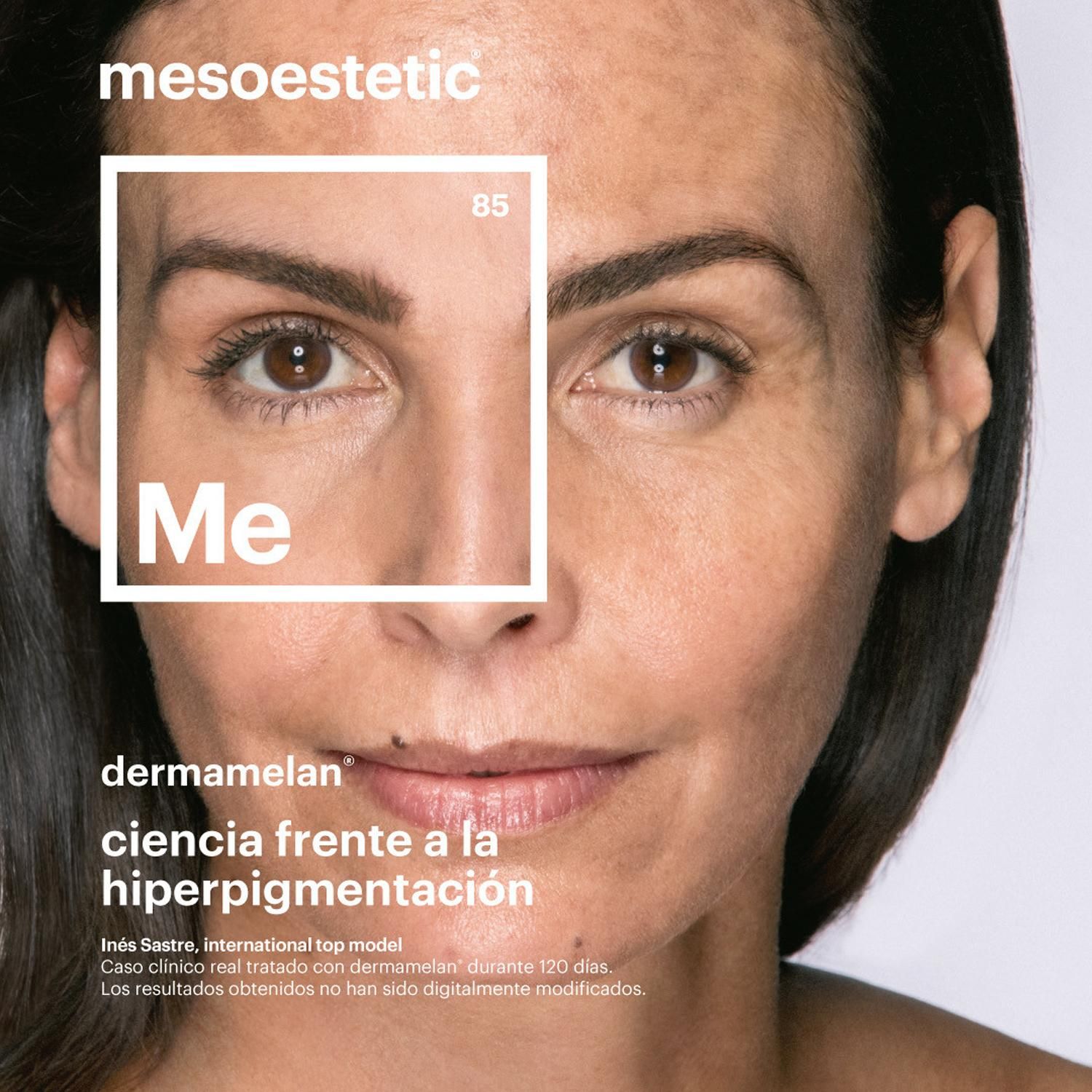 Dermamelan® es un método de despigmentación médico que actúa eliminando eficazmente las manchas