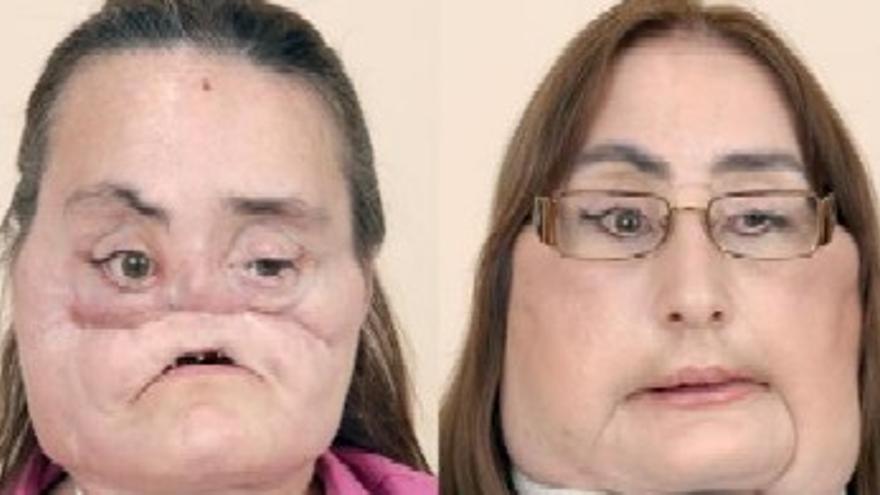 EEUU trasplanta el 80% del rostro de una mujer a la que su marido disparó en la cara