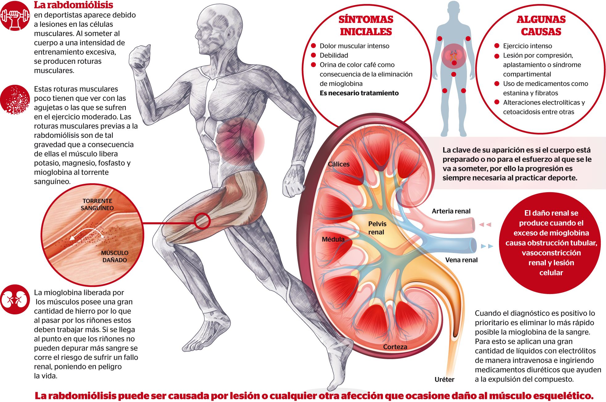 RABDOMILIOSIS