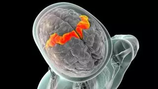 Primicia mundial: un implante cerebral permite hablar y cantar a una persona con esclerosis lateral amiotrófica (ELA)