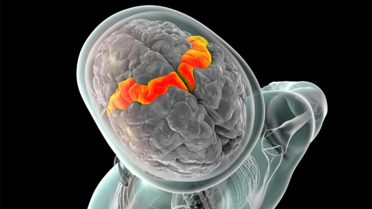 Primícia mundial: un implant cerebral permet parlar i cantar a una persona amb esclerosi lateral amiotròfica (ELA) Primícia mundial: un implant cerebral permet parlar i cantar a una persona amb esclerosi lateral amiotròfica (ELA)