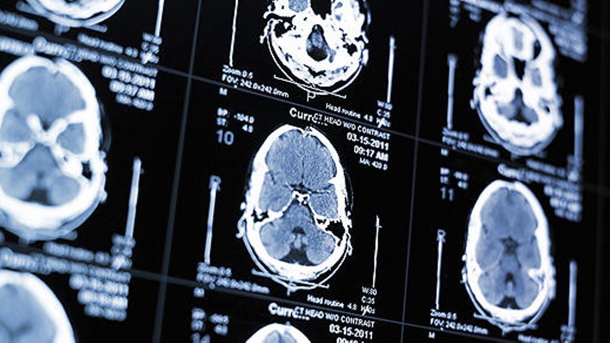 Un análisis de sangre podría permitir la detección ultra-temprana del Alzheimer