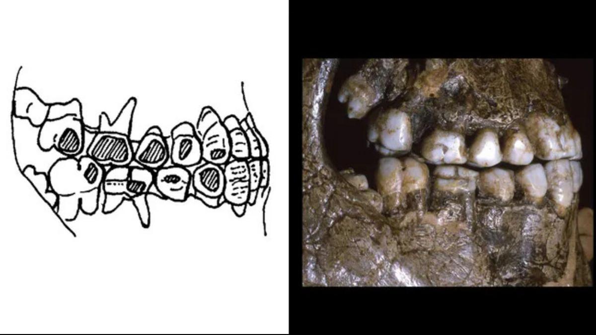 Un ejemplo de desgaste del esmalte en el lateral de los dientes por las perforaciones realizadas, en restos de la Edad de Hielo de Dolní Vestonice, actual República Checa.