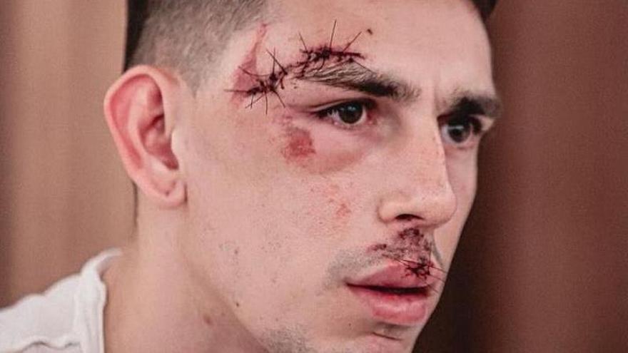 Así quedó el rostro de un exjugador de la UD Ibiza atacado a pedradas