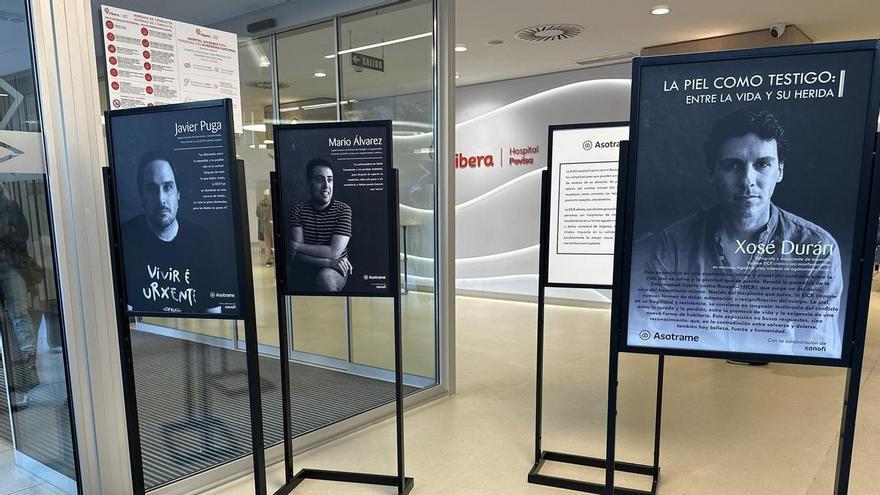 «La piel como testigo», la exposición que puede disfrutarse en Povisa