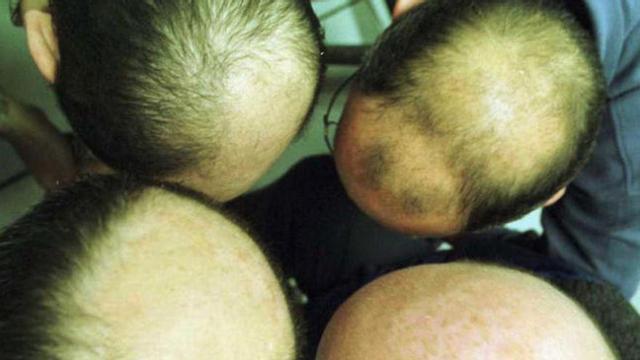 La crisis ha multiplicado los casos de alopecia
