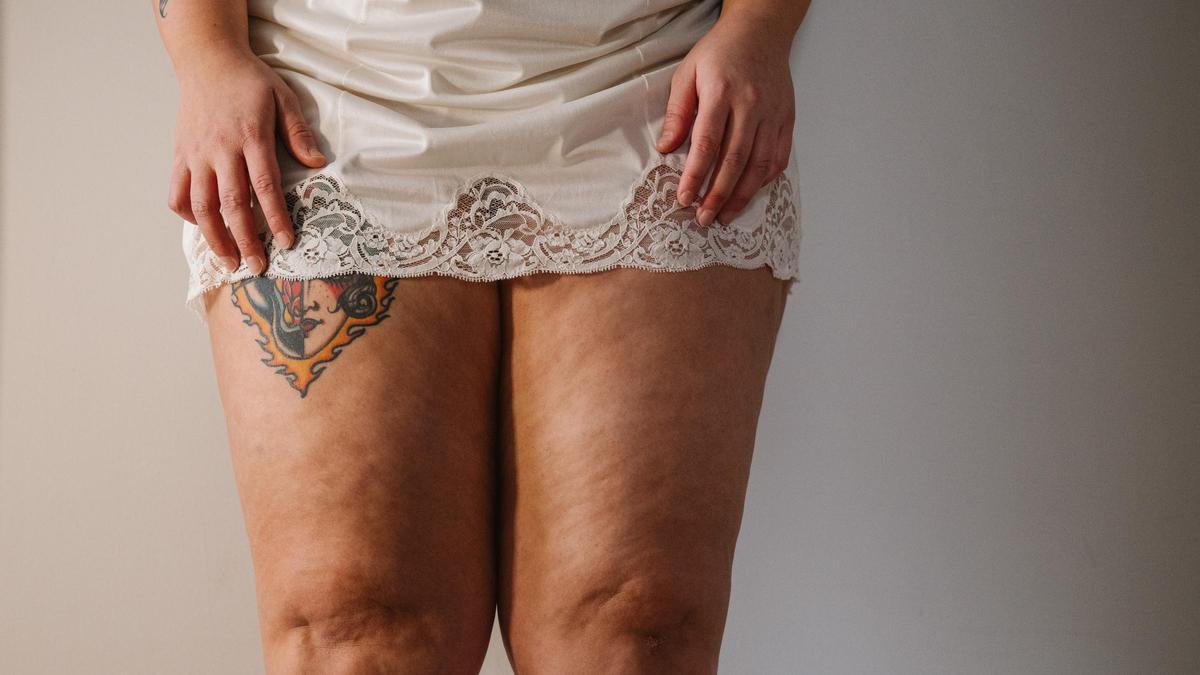 Las piernas de una afectada por lipedema
