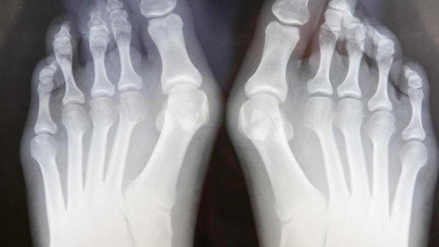 Radiografía de ambos pies mostrando los juanetes.