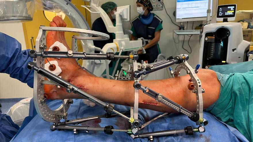 El Molina Orosa realiza su primera intervención para corregir una deformación ósea con fijador externo