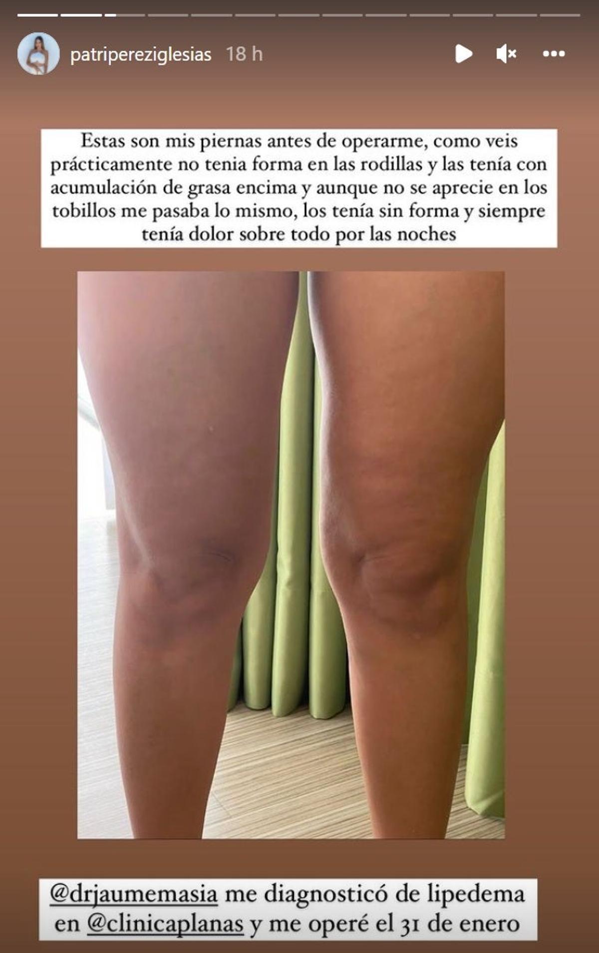 Patri Pérez y sus piernas, lipedema
