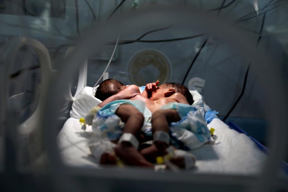Newly born conjoined twins lie in an incubator ...