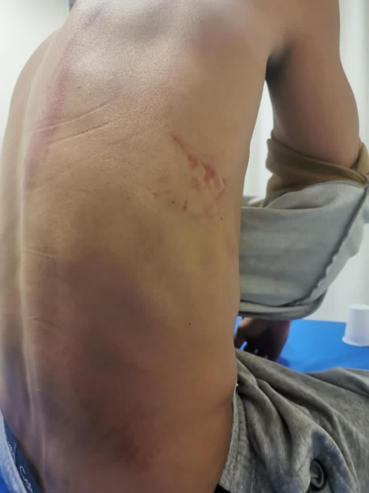 Kevin muestra sus heridas tras la trifulca Kevin muestra sus heridas tras la trifulca