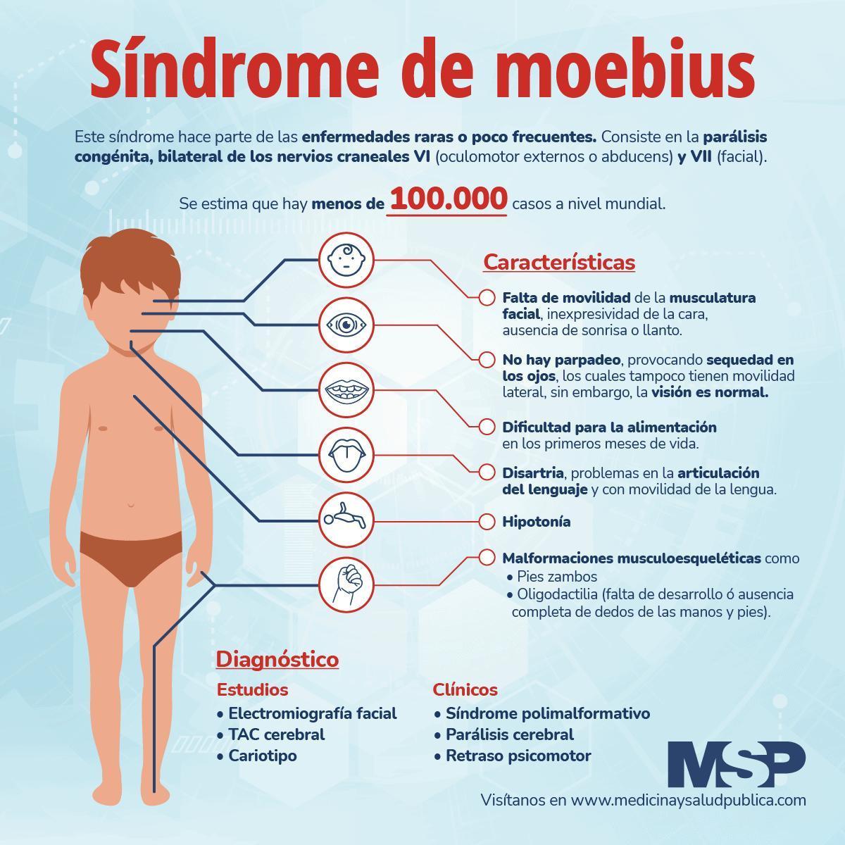 Sindrome de Moebius