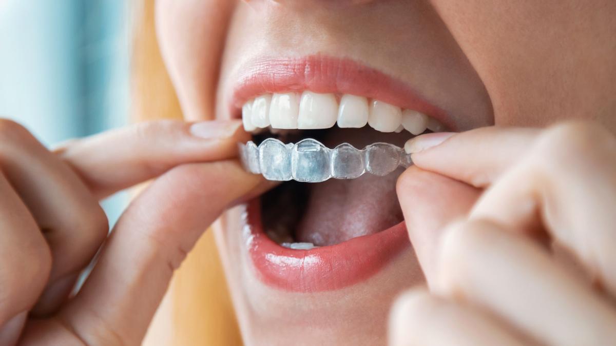 Ortodoncia invisible en Canarias: IOC Clínica Dental desarrolla su propio sistema de alineadores transparentes