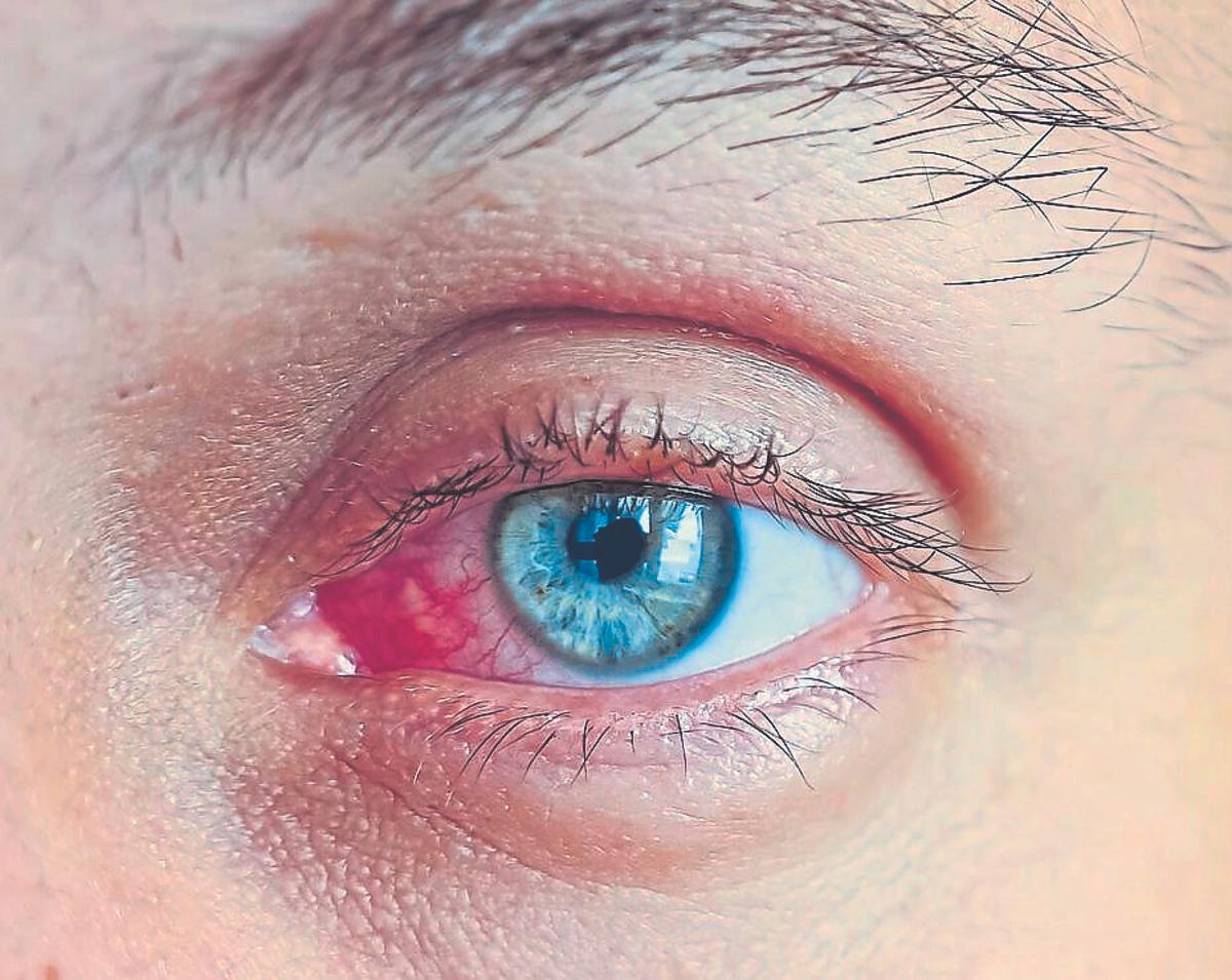 Un ojo con conjuntivitis alérgica