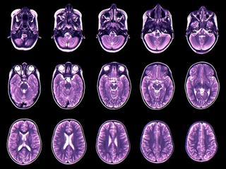 El cerebro se expande y encoge a lo largo de la vida