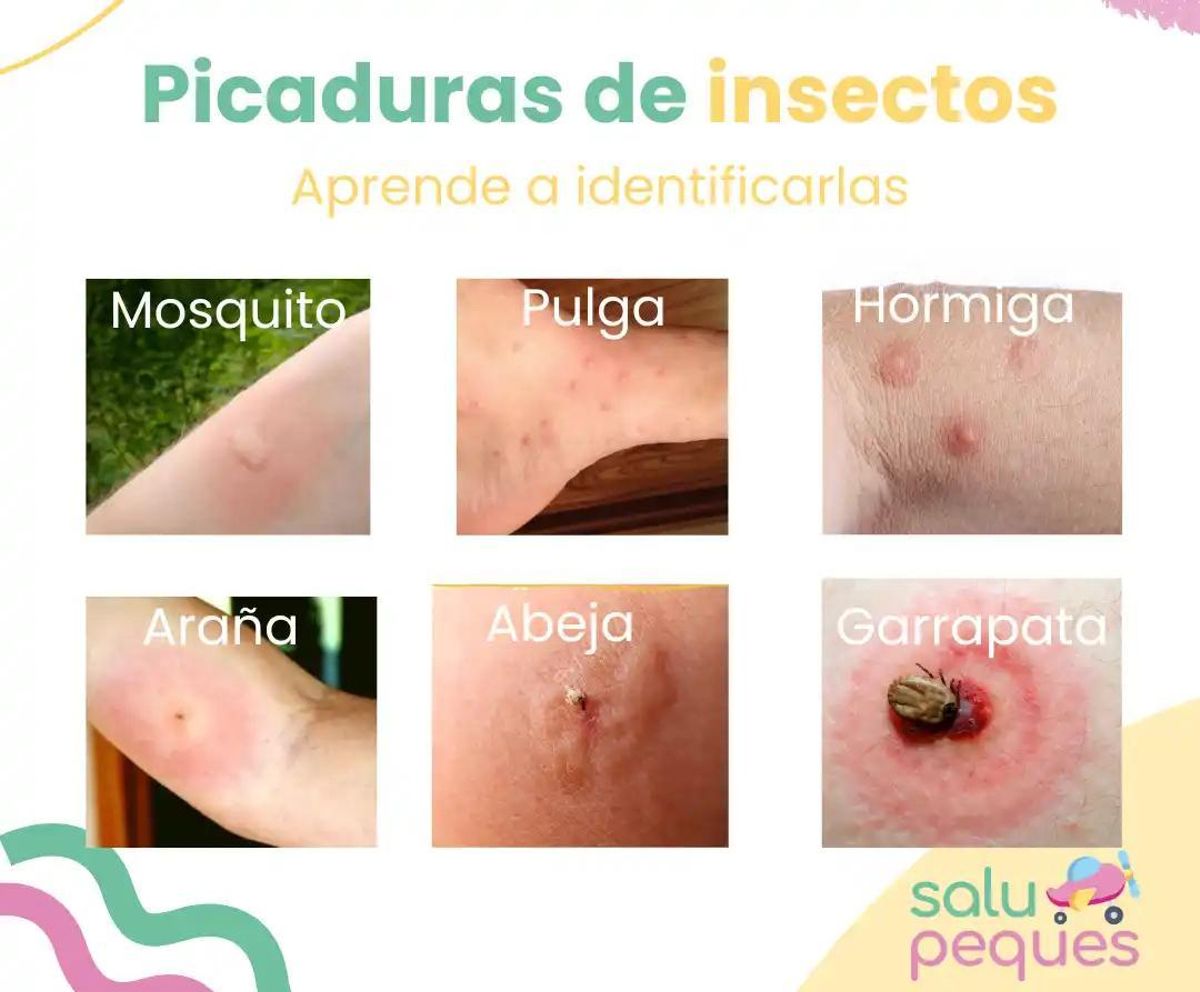 Diferentes tipos de picaduras de insectos en la piel