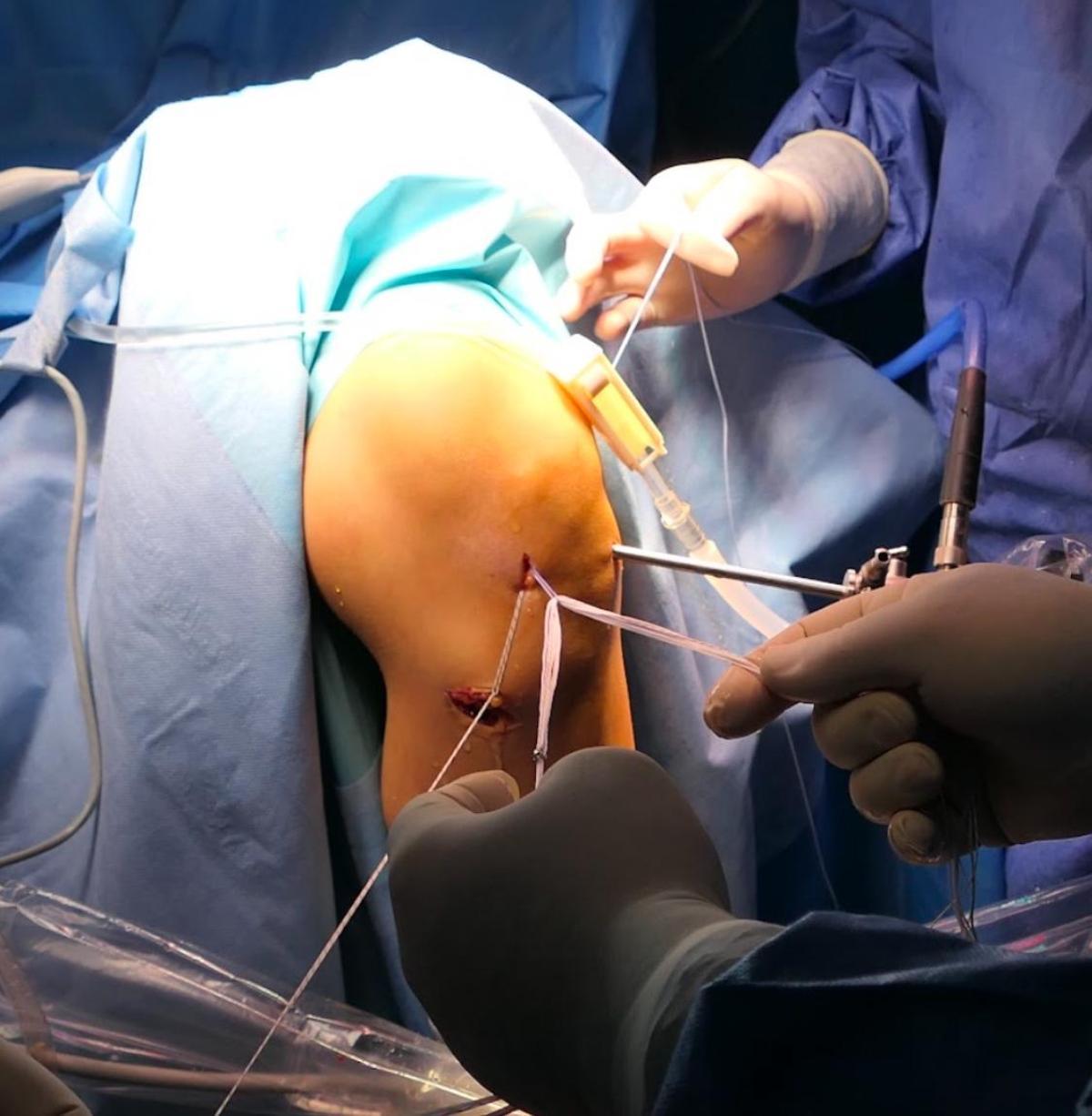 Ligamentoplastia del ligamento cruzado anterior con la técnica ‘All inside’ que reproduce mejor la anatomía con mejores resultados con bajo índice de rerotura.