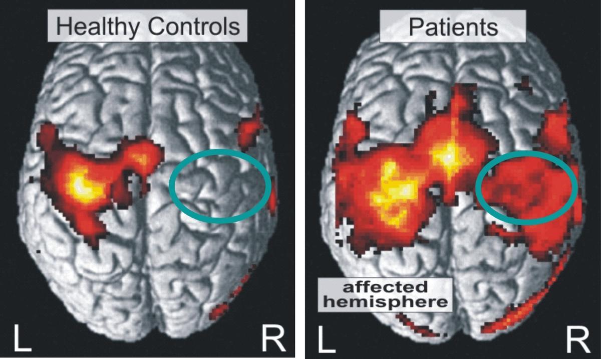 Activación cortical en sujetos sanos y pacientes con accidente cerebrovascular