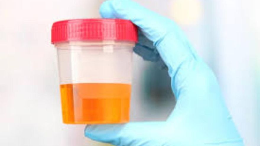 Convierten la orina humana en un material para implantes médicos