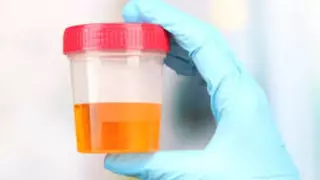 Convierten la orina humana en un material para implantes médicos